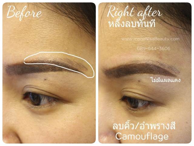 View Only Photos Of Correction And Removal Of 3d Eyebrow Tattoo Monanisa Beauty